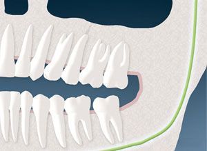 A close up of a person 's teeth with a green line between them.