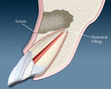 A diagram of a tooth with a suture and root end filling