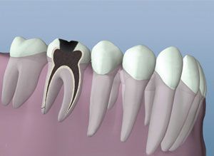A computer generated image of a tooth with a hole in it.