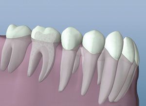 A close up of a row of teeth in a person 's mouth.