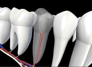 A computer generated image of a row of teeth with a root canal in one of them.