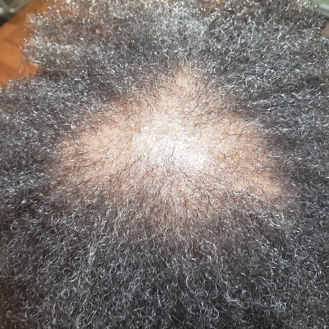 A top-down view of a scalp showing an area of thinning hair and visible skin at the crown.