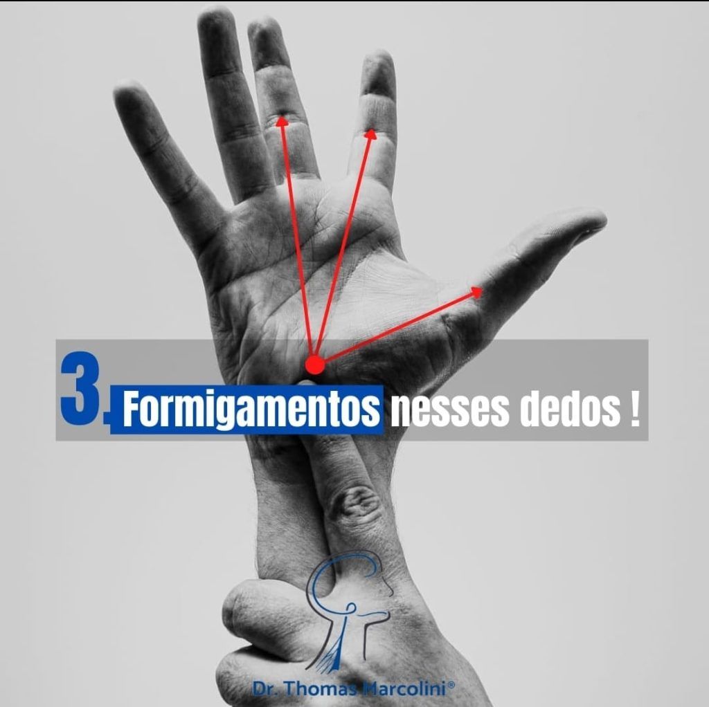 Mão com setas indicando os dedos afetados com túnel do carpo e o texto