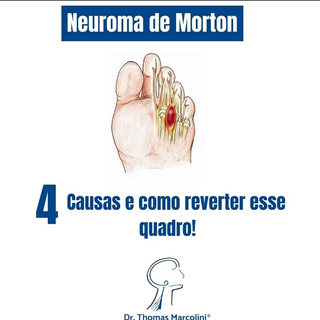 Como melhorar do neuroma de morton 4 causas do neuroma de morton e como reverter