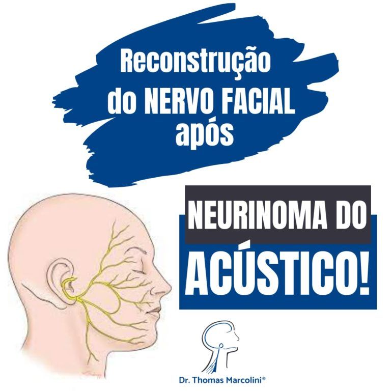 Nervo facial após neurinoma do acústico Tratamentos Em 2023. neurinoma do acústico