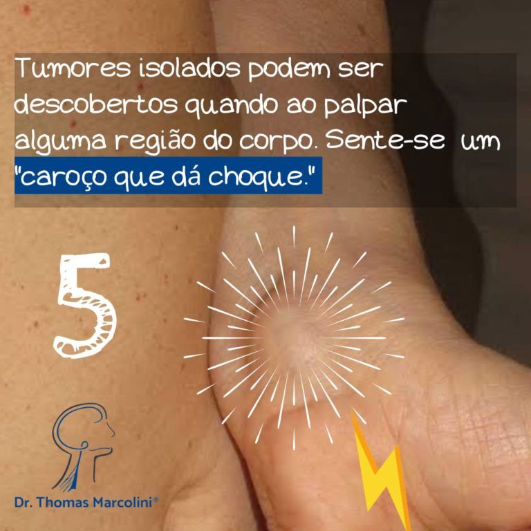 Braço com nervo destacado, tumor da bainha do nervo periférico causa sensação de choque ao palpar