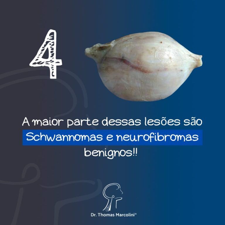 Espécime cirúrgico de tumor removido, maioria dos casos são schwannomas e neurofibromas benignos