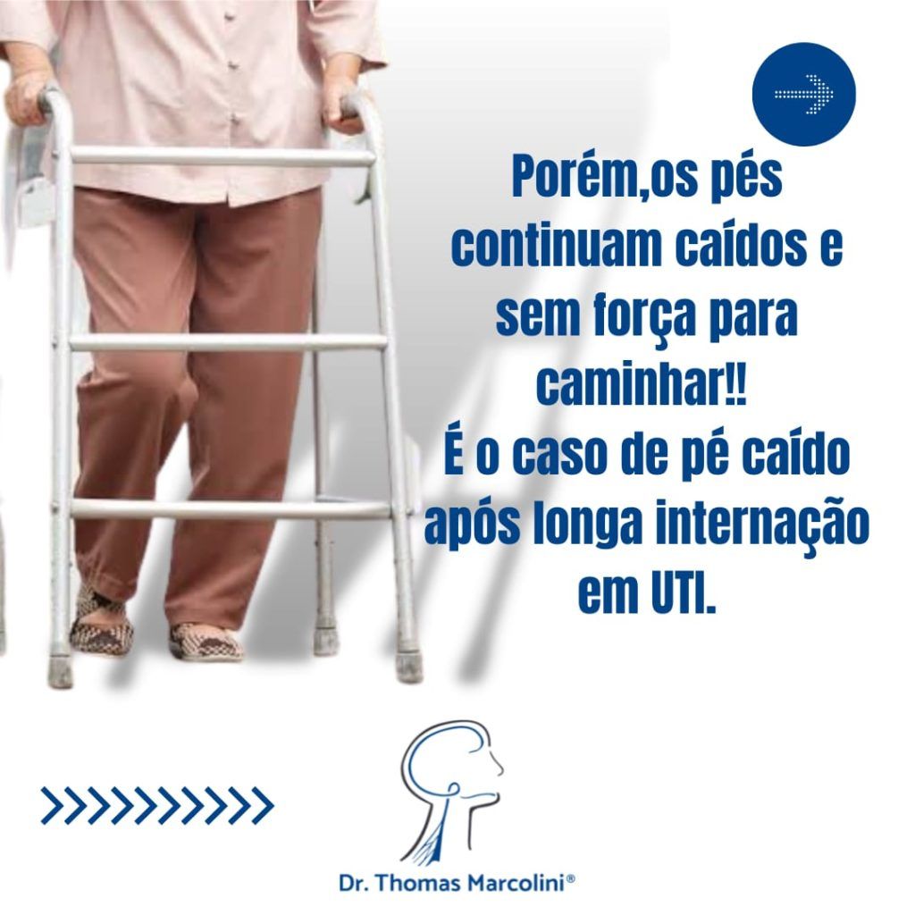 Síndrome do pé caído - Movimento dos pés Síndrome do pé caído - Movimento dos pés