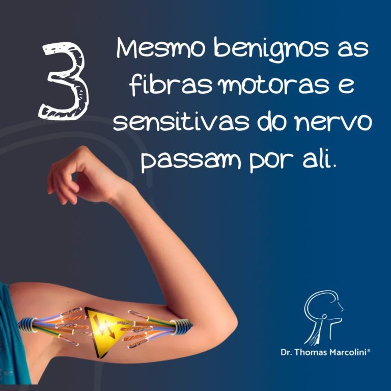 Ilustração de braço mostra fibras motoras e sensitivas do nervo periférico ao redor do tumor
