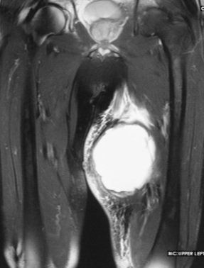 Médico para schwannoma de nervos periféricos Médico para tumores da bainha dos nervos periféricos