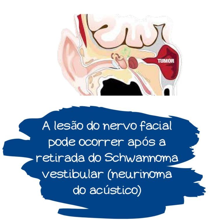schwannoma vestibular e o nervo facial schwannoma vestibular