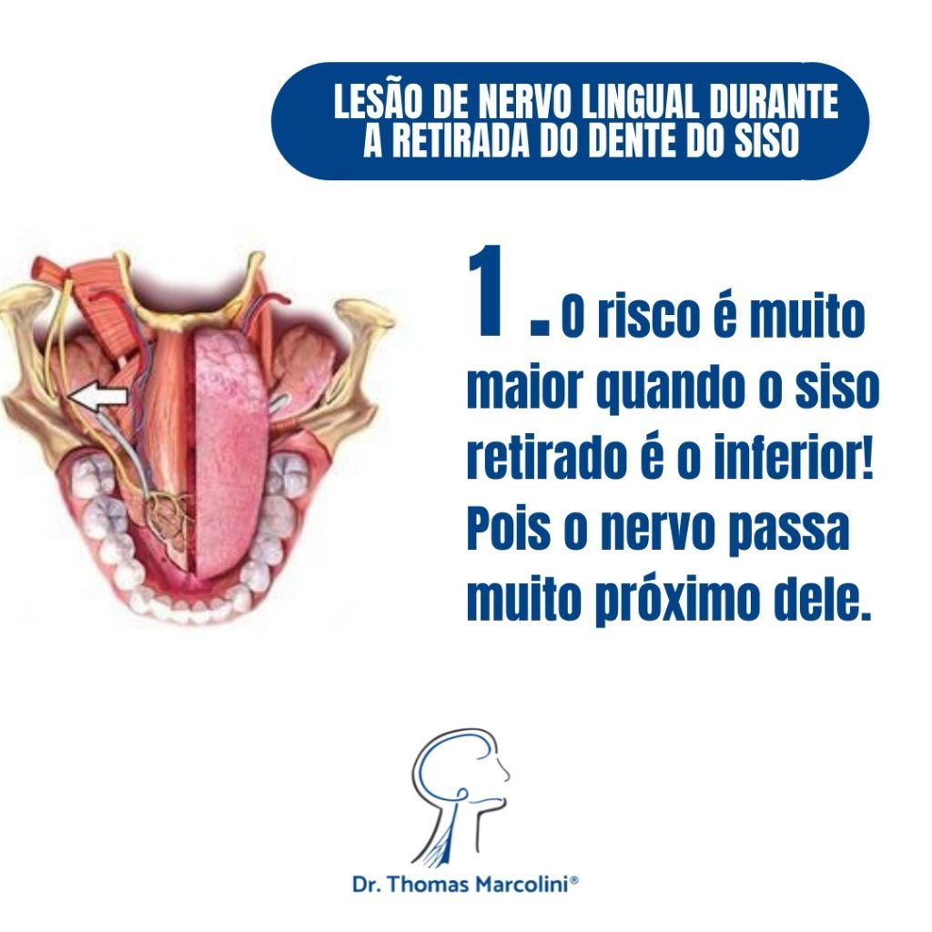 Lesão de nervo lingual durante a retirada do siso