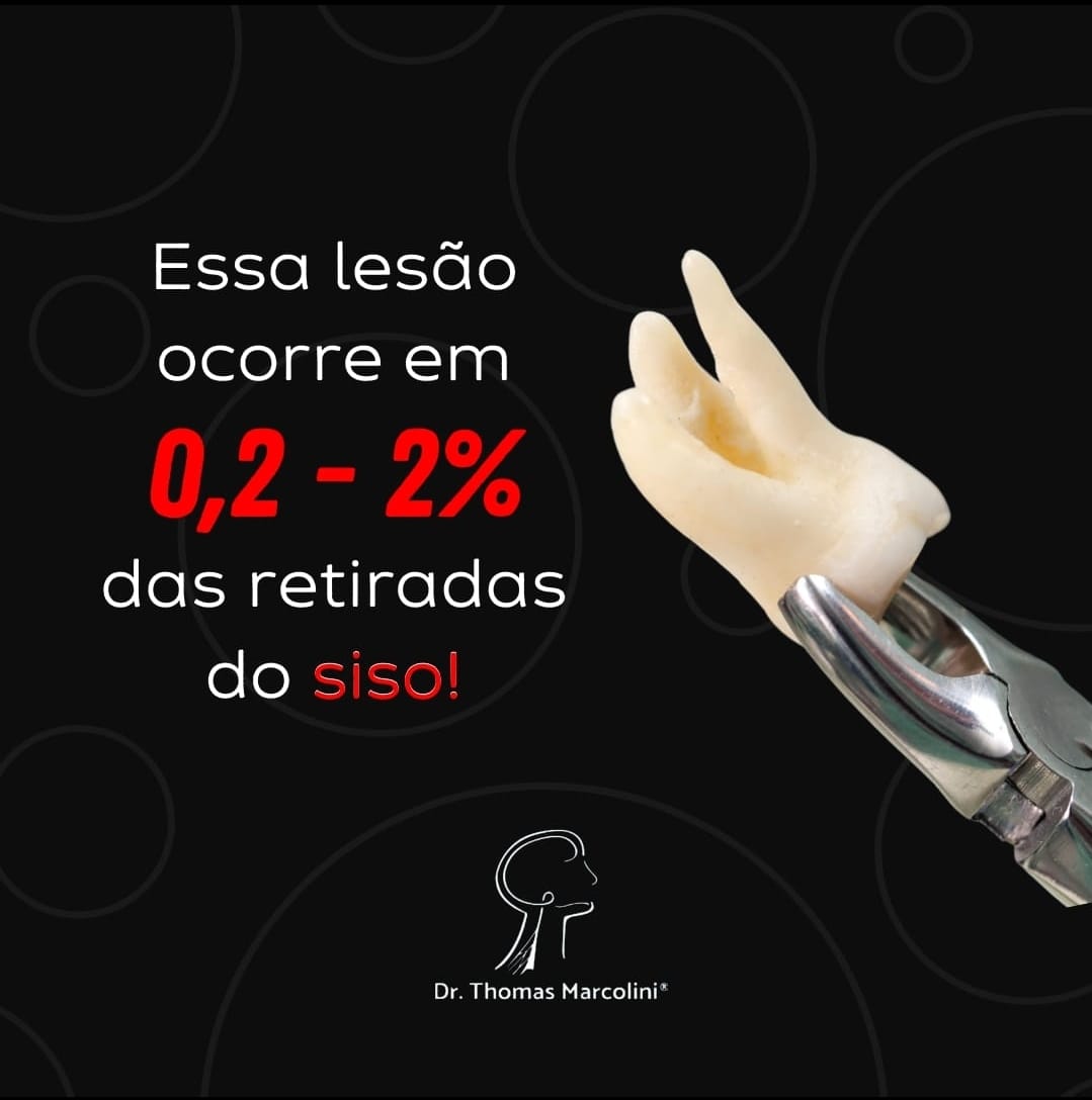 Infográfico com dente do siso sendo extraído e o texto 