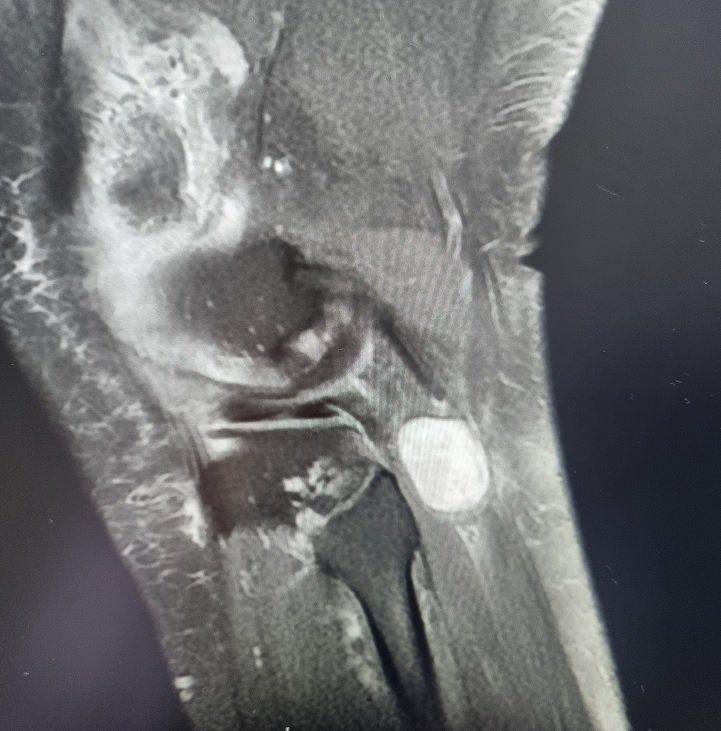 Médico para Tumores de Nervos schwannoma Médico para Tumores de Nervos Periféricos