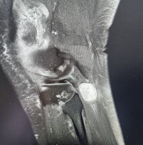 Médico para Tumores de Nervos schwannoma Médico para Tumores de Nervos Periféricos