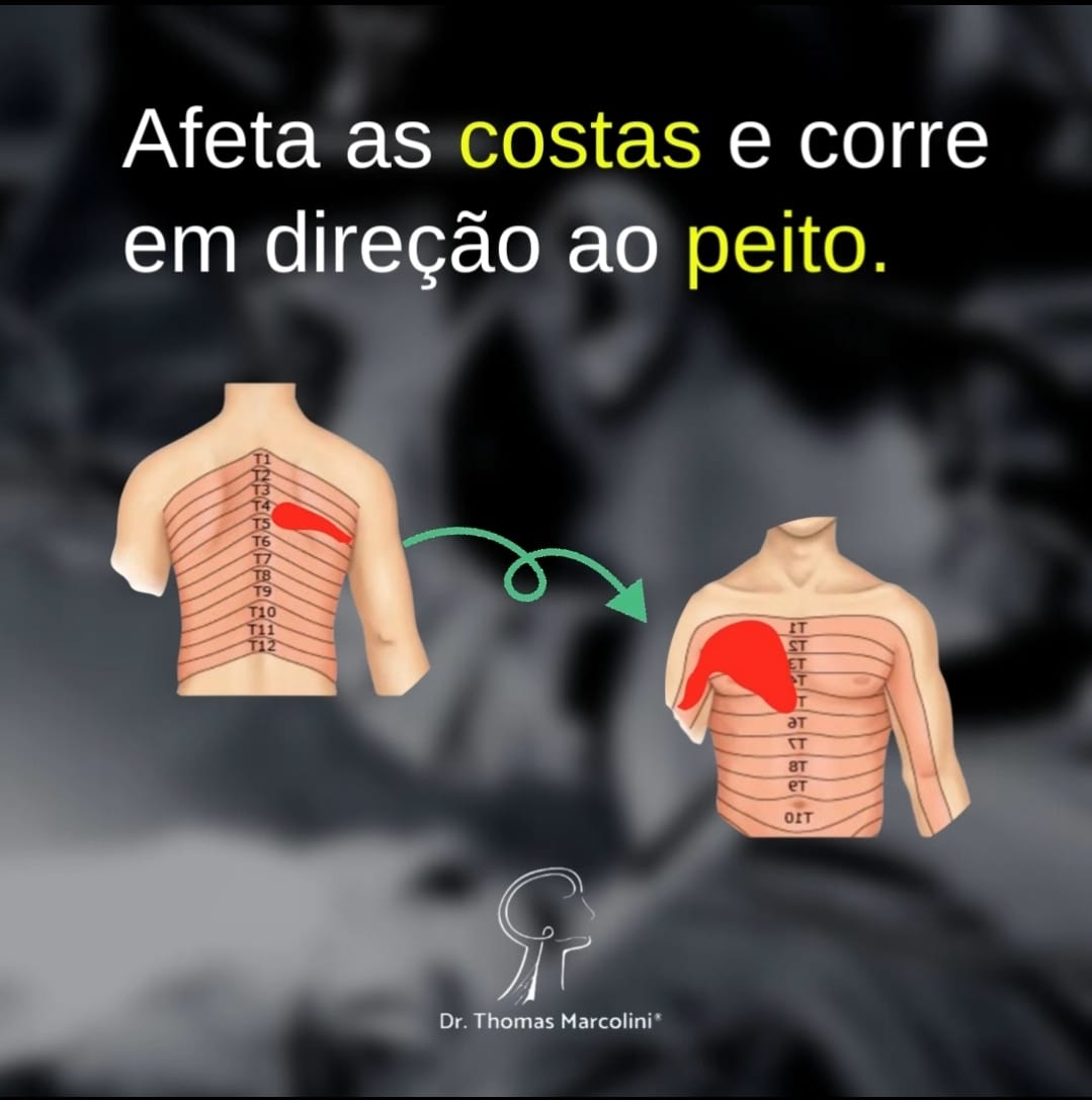 Formigamentos das costas para a barriga pode ser neuropatia do intercostal. A inflamação do nervo da costela. Queimação e choques nas costas para o peito pode ser neuropatia intercostal.