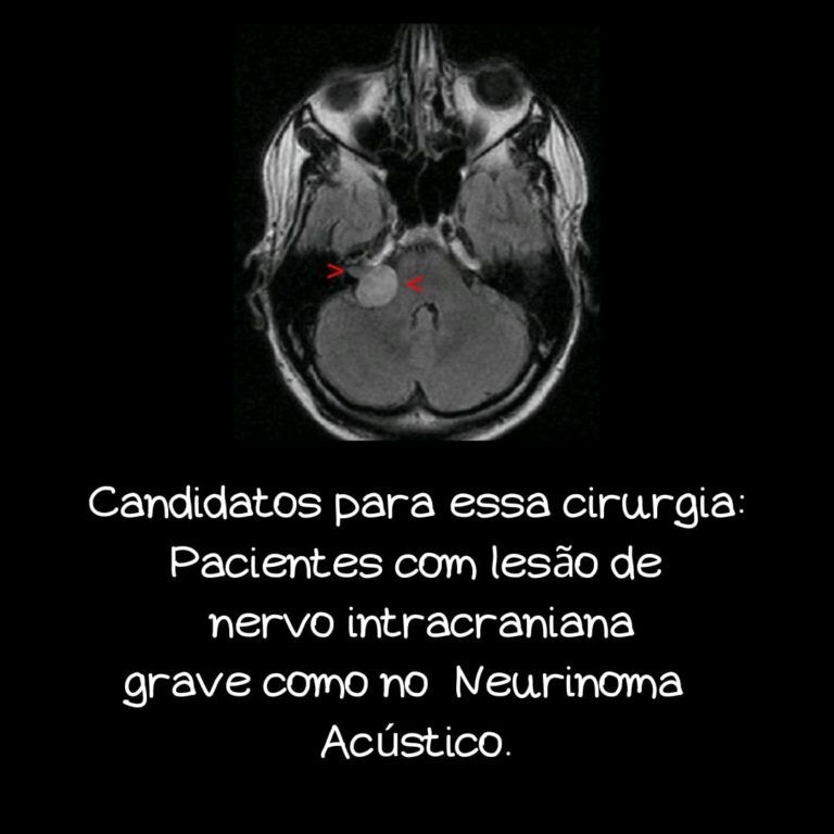 neutotização do hipoglosso para o nervo facial neutotização após lesão do facial em neurinoma do acústico