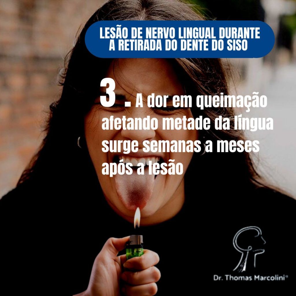 Dor e queimação na língua depois da retirada do siso