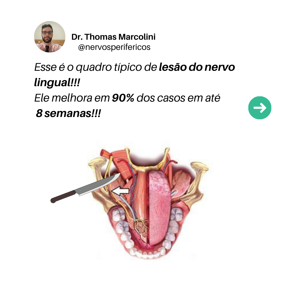 Ilustração anatômica da boca mostrando o trajeto do nervo lingual próximo ao dente do siso durante a extração cirúrgica