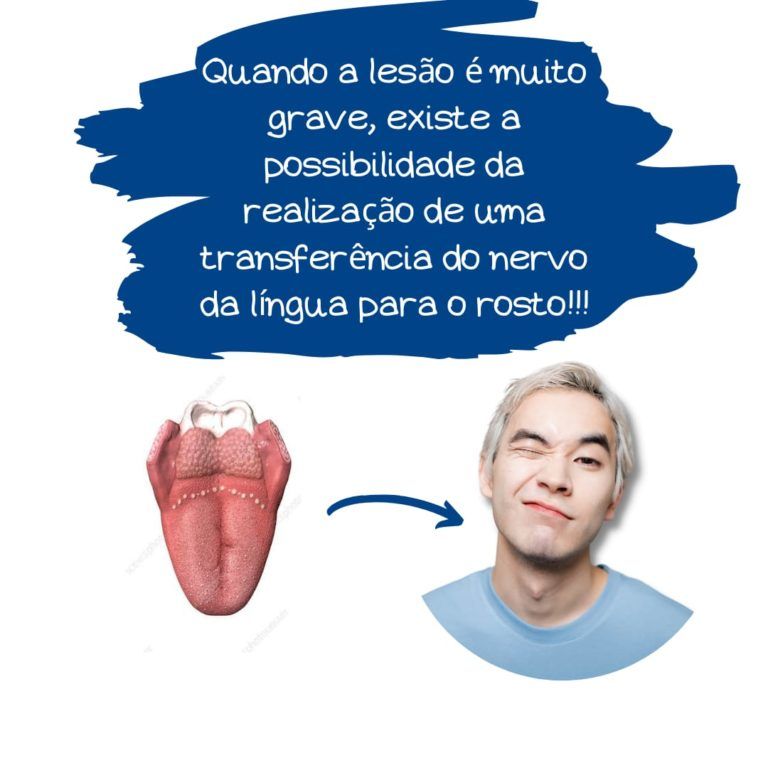 transferência do nervo hipoglosso neurotização do nervo hipoglosso