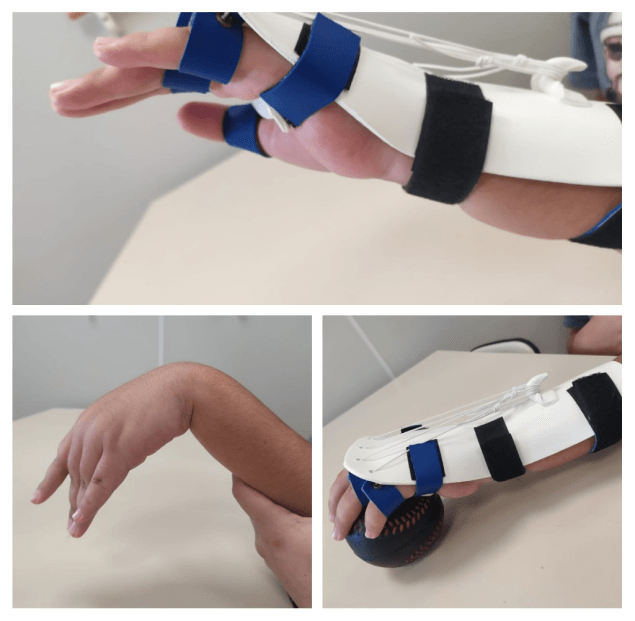 Terapia ocupacional para lesão de plexo braquial