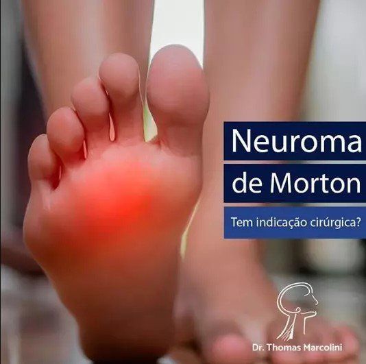 O que é neuroma de morton? Médico Especialista em Neuroma de Morton