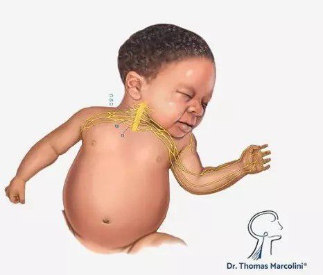 Médico especialista em lesão de plexo braquial em bebês