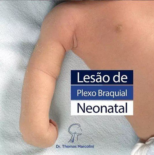 O que é lesão do plexo braquial obstétrica?