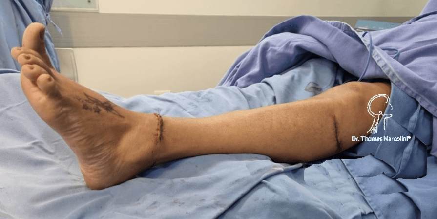 Pé em recuperação após cirurgia, tratamento e fisioterapia da síndrome do pé caído