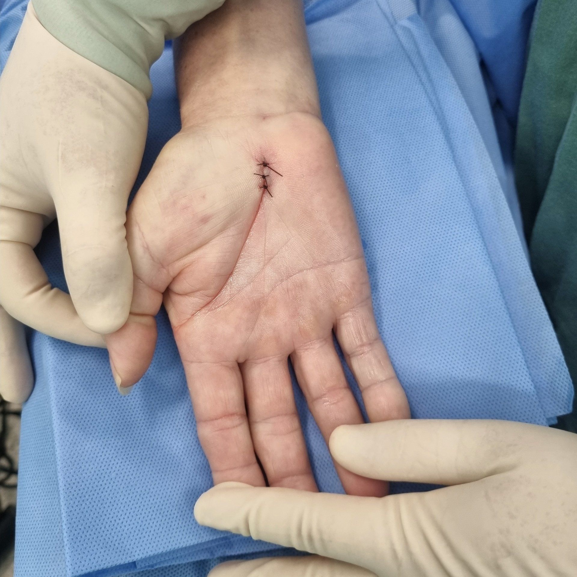 Médico para túnel do carpo em curitiba (trata o nervo apertado). Médico para lesões compressivas de nervos periféricos (nervo apertado).