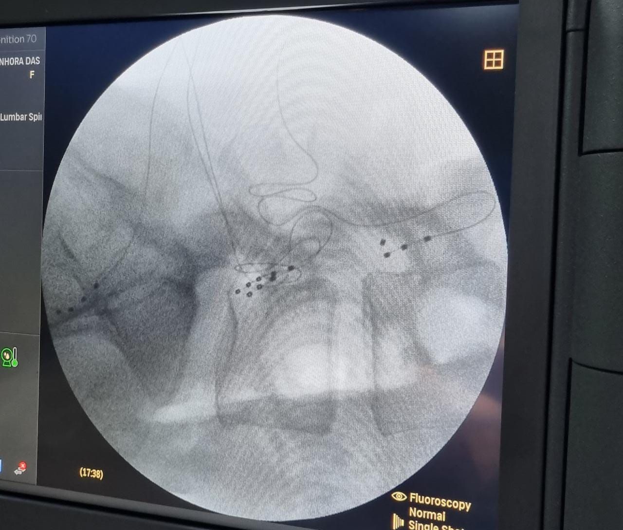 Eletrodos implantados no ganglio da raiz dorsal (DRG) para dor complexa regional