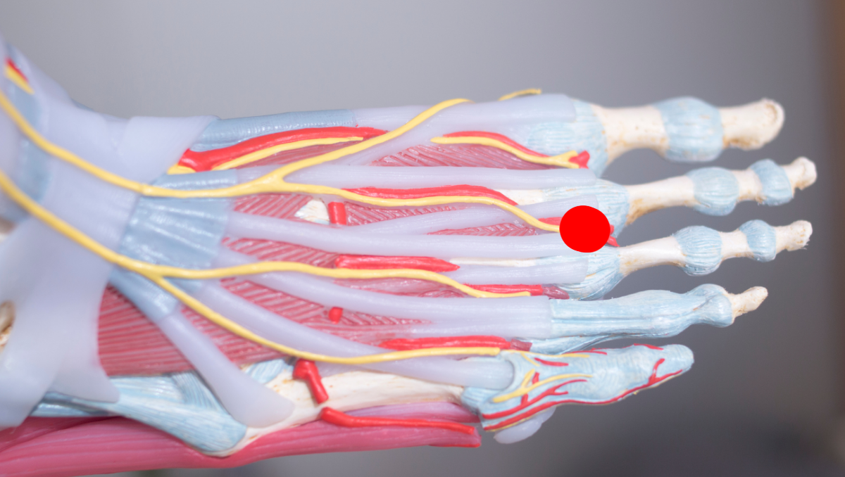 Quais são as causas do Neuroma de Morton? Quais são as causas do Neuroma de Morton?