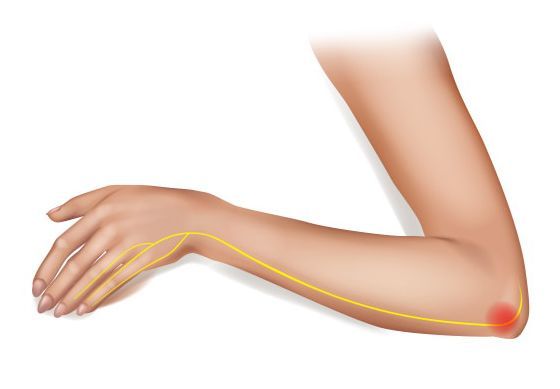 Ilustração do braço dobrado com cotovelo destacado em vermelho, dormir nessa posição piora a compressão do nervo ulnar