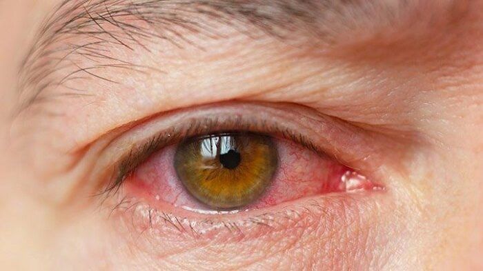 Close-up de olho vermelho e irritado, sintoma ocular comum na paralisia facial