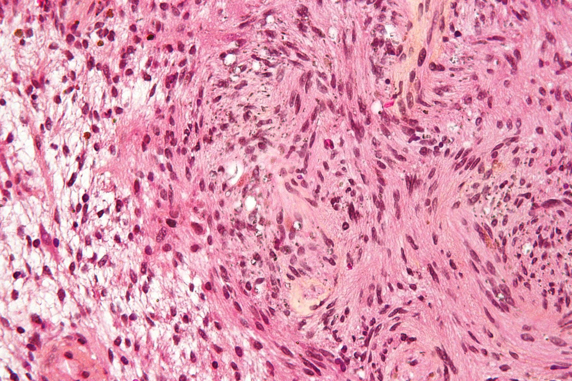 Médico para schwannoma de nervos periféricos em SP. Médico para Schwannoma em São paulo capital.
