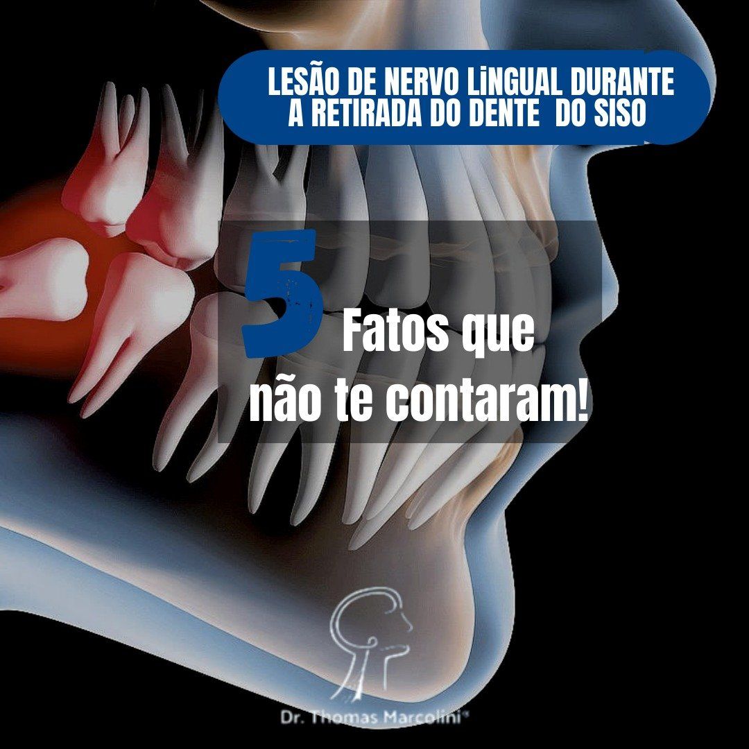 Lesão Do Nervo Lingual – O Que Sabemos Dessa Lesão Em 2022!