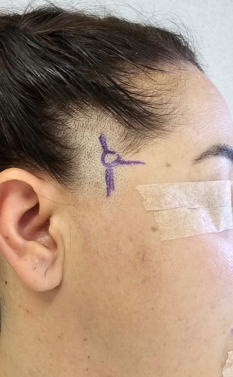 médico Neurocirurgião para Cirurgia de Dor de Cabeça Médico cirurgião para Cirurgia de Dor de Cabeça