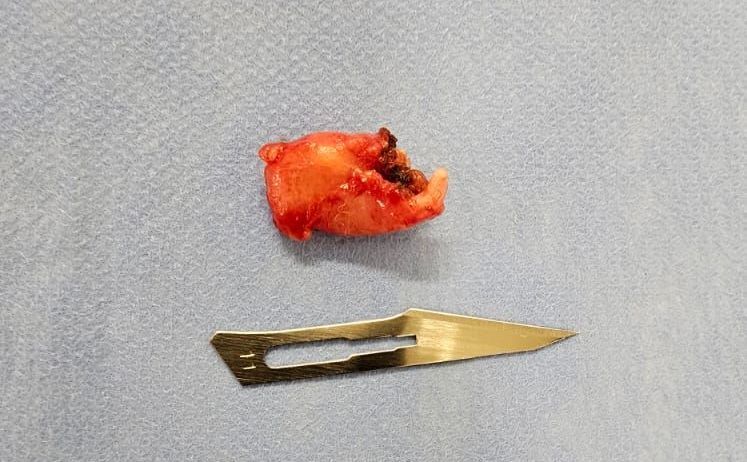 Neuroma doloroso da perna