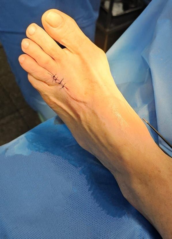 médico que faz cirurgia de neuroma de morton
