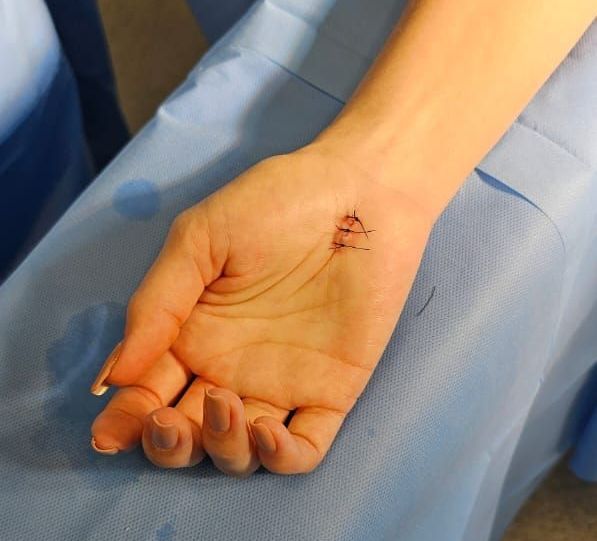 Como é feita a cirurgia para síndrome do túnel do carpo? Como é feita a cirurgia para síndrome do túnel do carpo?