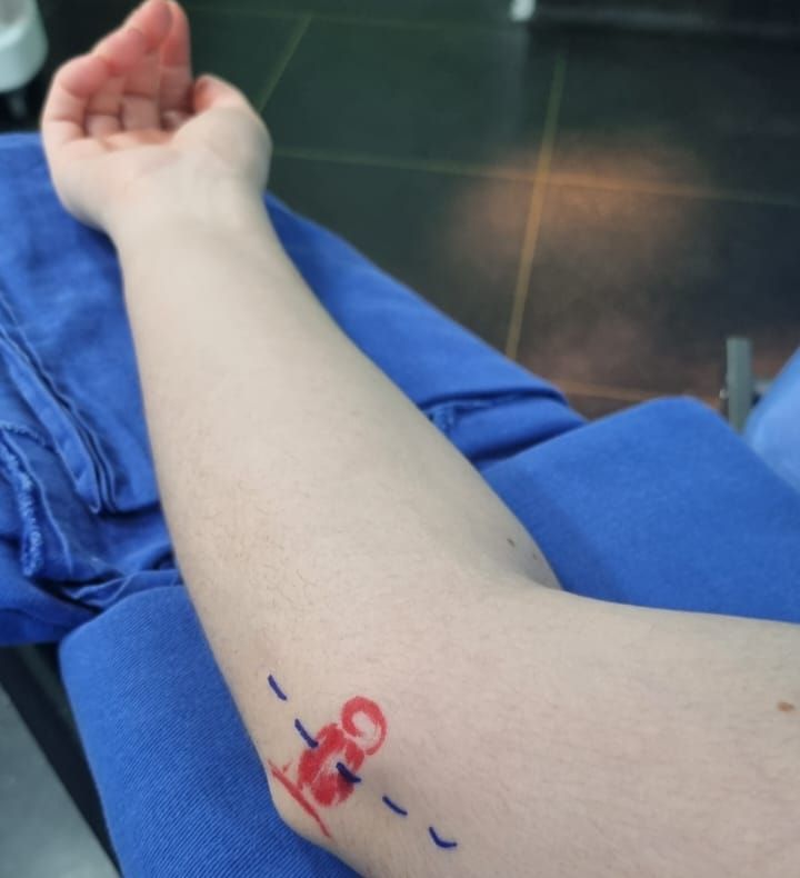 Qual o risco do tumor da bainha do nervo.