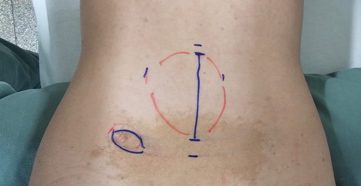 Médico especialistas em Schwannoma em são paulo. Médico para Tratamento de tumor da bainha do nervo em são paulo.