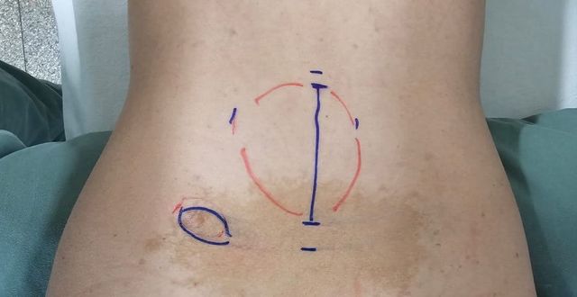 Médico Especialista em Tumor da bainha do Nervos em São Paulo