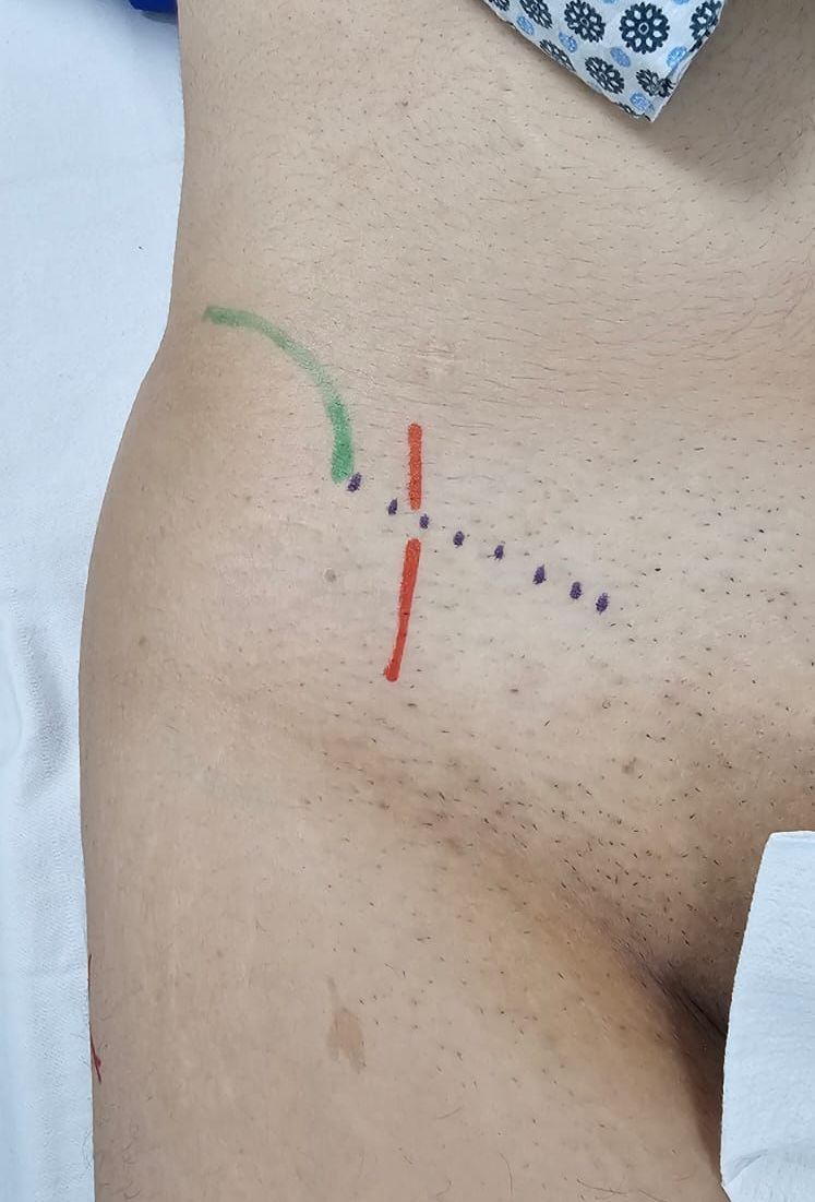 médico especialista em meralgia parestésica