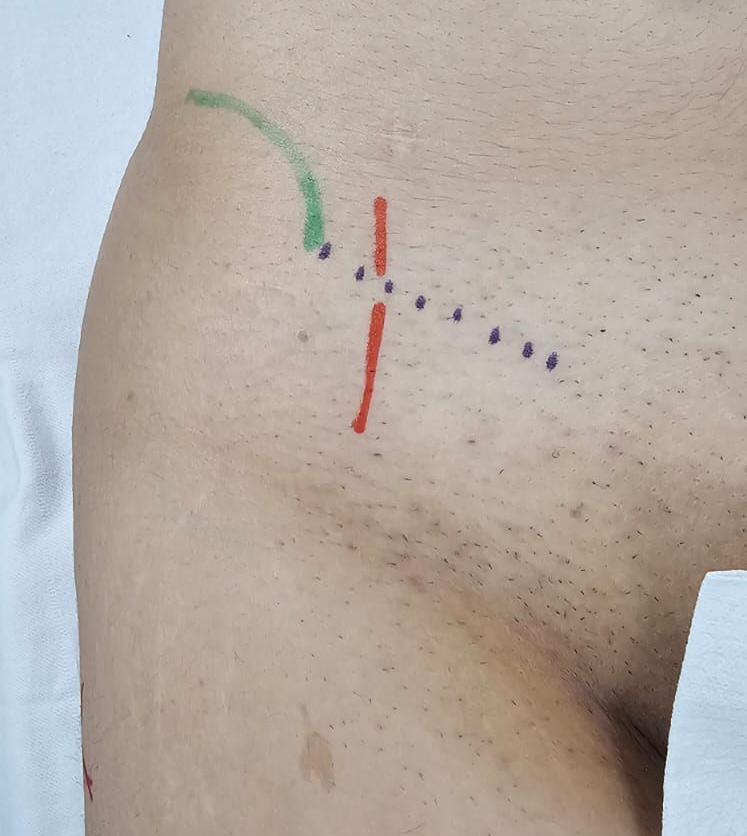 Marcação cirúrgica na região da coxa mostrando o trajeto do nervo cutâneo femoral lateral para tratamento da Meralgia Parestésica.