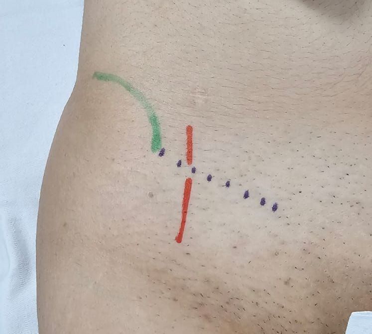 Neuroma doloroso da perna.