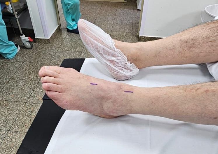 É possível que o pé volte ao normal após a cirurgia?