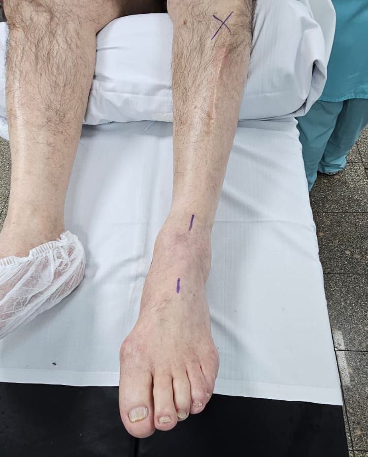Médico especialista na síndrome do pé caído em São paulo. Como funciona a cirurgia do pé caído em são paulo.