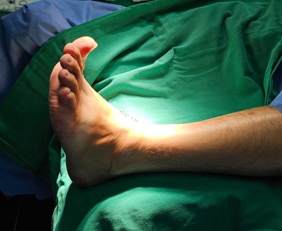 Como é feita a cirurgia do pé caído?
