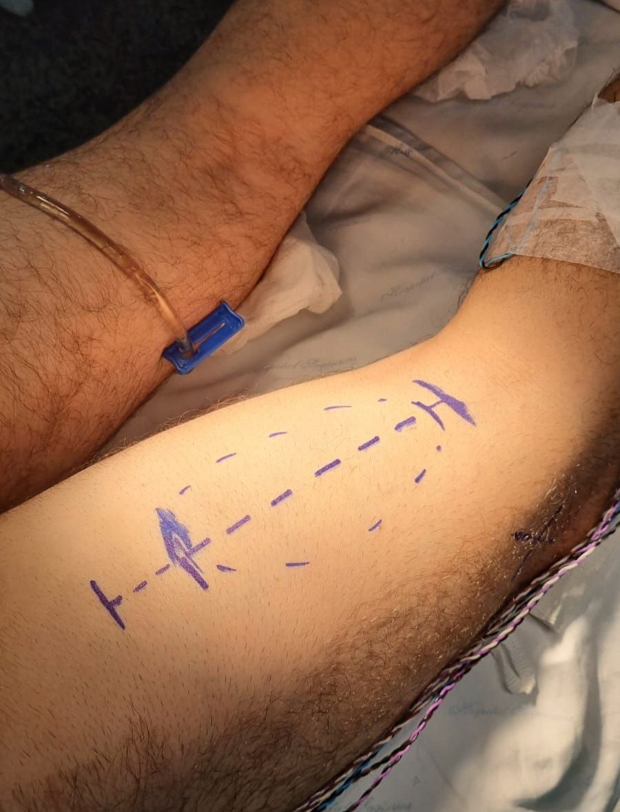 Médico para tumores da bainha dos nervos periféricos de Curitiba no paraná.